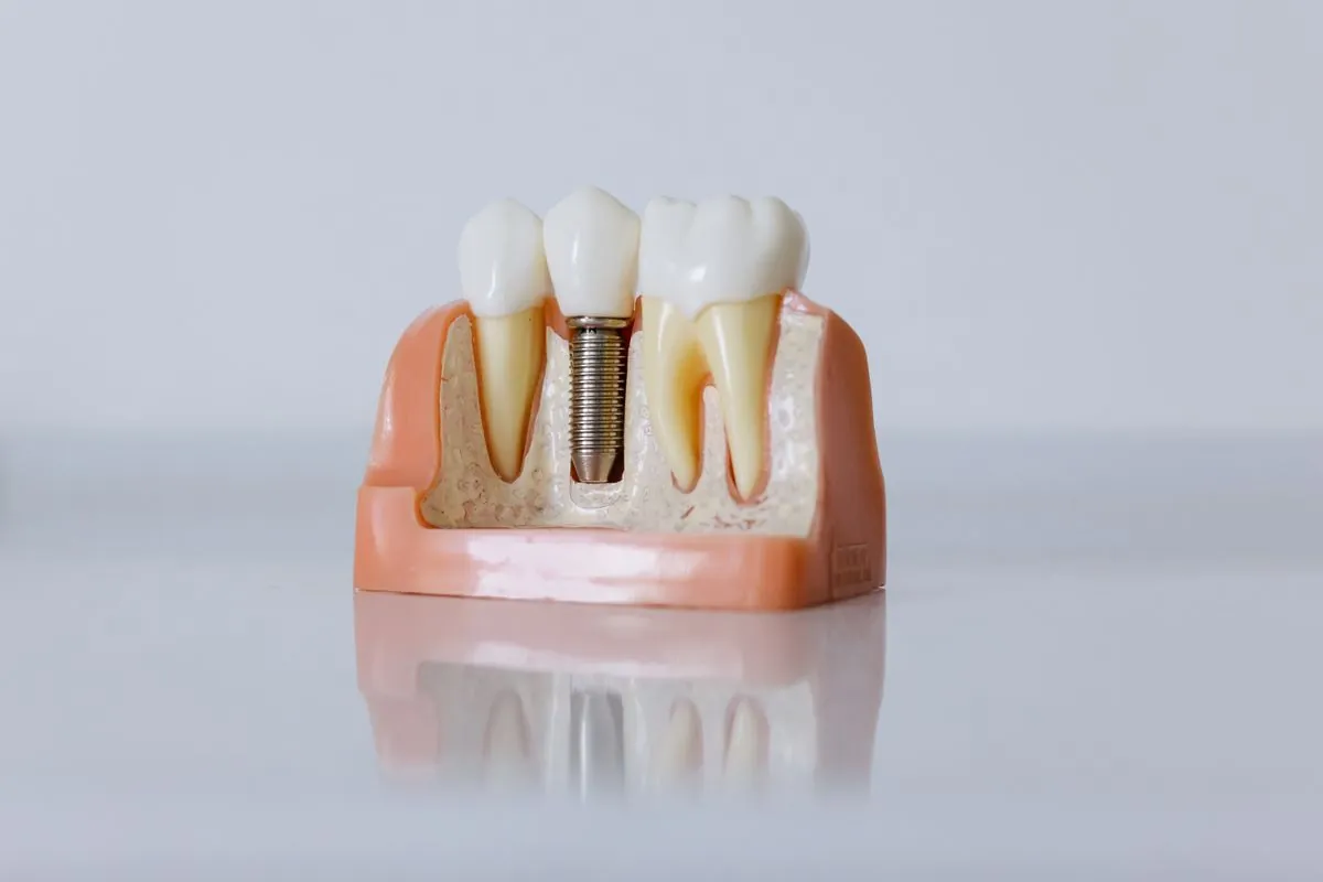 Fogászati modell: implantátum a természetes fogak között, a csontban rögzülve